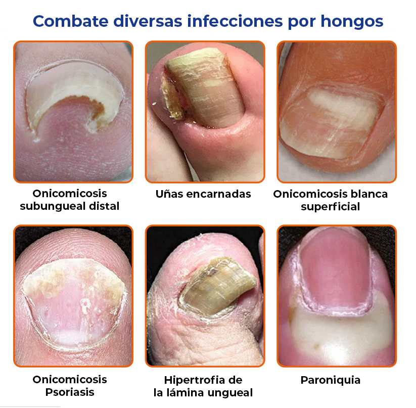 Joy Pretty® -Elimina los hongos de las uñas