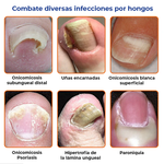 Joy Pretty® -Elimina los hongos de las uñas