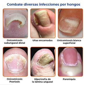 Joy Pretty® -Elimina los hongos de las uñas
