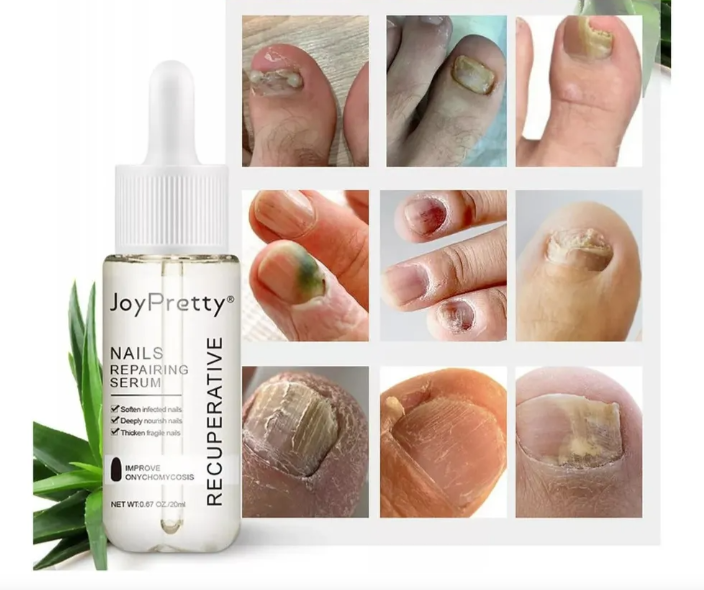 Joy Pretty® -Elimina los hongos de las uñas