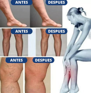 PARCHES PARA VÁRICES